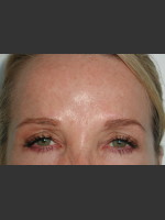 After Photo Serene Procedure (Nuebelle) - Prejuvenation Before & After