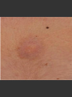 After Photo Treatment of Tattoo - Prejuvenation Before & After