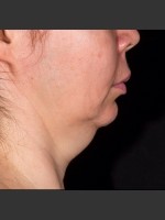 Before Photo SculpSure Submental - Prejuvenation Before & After
