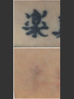 Before Photo Laser Treatment of Tattoo - Prejuvenation Before & After