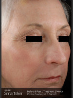 After Photo Wrinkle Reduction With SmartSkin Resurfacing - Prejuvenation Before & After