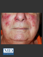 Before Photo Rosacea Treatment 102 - Prejuvenation Before & After