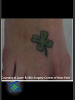Before Photo Laser Treatment of Foot Tattoo - Prejuvenation Before & After