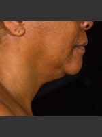 After Photo SculpSure Submental - Prejuvenation Before & After