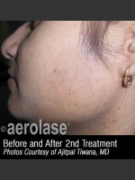 After Photo Hair Removal #310 - Prejuvenation Before & After