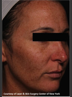 Before Photo Facial Skin Rejuvenation with Clear and Brillant Permea - Prejuvenation Before & After