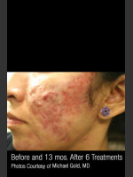 Before Photo #301 - Treatment of Cystic Acne - Prejuvenation Before & After