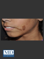 Before Photo Birthmark Cafe Au Lait Macule Treatment 112 - Prejuvenation Before & After