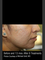 After Photo Treatment of Cystic Acne #302 - Prejuvenation Before & After