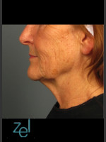Before Photo Ultherapy on Mid Face with Dermal Fillers - Prejuvenation Before & After