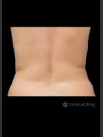 After Photo CoolSculpting Before & After on Woman - Prejuvenation Before & After