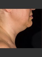 Before Photo SculpSure Submental - Prejuvenation Before & After
