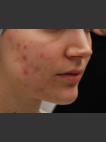 Before Photo Fractora #1 - Prejuvenation Before & After