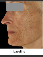 Before Photo DefenAge Skincare Clinical Power Trio - Prejuvenation Before & After