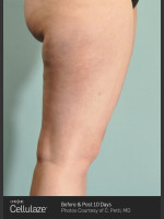 After Photo Cellulaze Cellulite Treatment of the Thighs - Prejuvenation Before & After