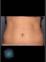 Before Photo Treatment of Lower Abdomen with CoolSculpting - Prejuvenation Before & After