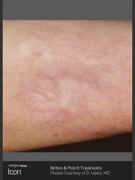 After Photo Scar Reduction Using Icon 1540 - Prejuvenation Before & After