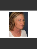 After Photo Chin Contouring & Sun Damage Treatment - Prejuvenation Before & After