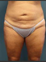 Before Photo Before and After Tummy Tuck - Prejuvenation Before & After