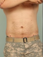 After Photo Liposuction - Prejuvenation Before & After