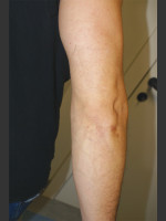 After Photo Quanta Q-Plus C Laser Tattoo Removal #71 - Prejuvenation Before & After