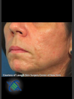 After Photo Treatment of Lower Face Acne Scarring - Prejuvenation Before & After