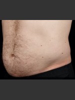 Before Photo SculpSure Abdomen - Prejuvenation Before & After