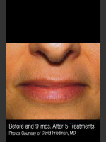 After Photo Hair Removal #312 - Prejuvenation Before & After