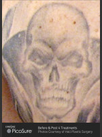 Before Photo Tattoo Removal of Skull - Prejuvenation Before & After