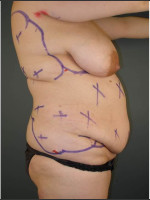 Before Photo Liposuction #44 Side View - Prejuvenation Before & After