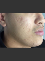After Photo Microneedling  - Prejuvenation Before & After