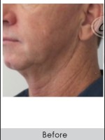 Before Photo Male Jawline Enhancement with Radiesse - Prejuvenation Before & After