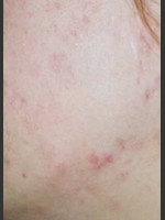 After Photo Quanta Eterna IPL Acne Treatment #79 - Prejuvenation Before & After