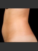 Before Photo SculpSure Abdomen - Prejuvenation Before & After