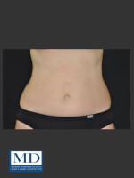 After Photo  Body Contouring Treatment 142 - Prejuvenation Before & After