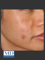 Before Photo Post Inflammatory Hyperpigmentation 119 - Prejuvenation Before & After