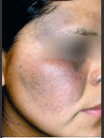 Before Photo Quanta MDK Nevus of Ota Treatment #76 - Prejuvenation Before & After