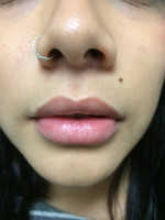 After Photo Juvederm Injection  - Prejuvenation Before & After
