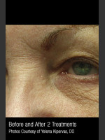After Photo Treatment of Facial Pigmentation #330 - Prejuvenation Before & After