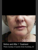 Before Photo Skin Tightening #342 - Prejuvenation Before & After