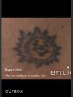 Before Photo Tattoo Removal Before & After Photo of Sun - Prejuvenation Before & After