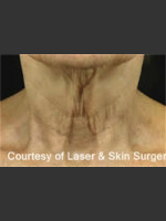Before Photo Treatment of Fine lines and Wrinkles - Prejuvenation Before & After