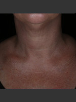Before Photo Alastin Skincare Restorative Neck Complex with TriHex Technology® - Prejuvenation Before & After