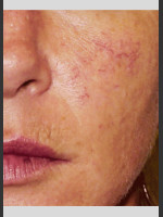 Before Photo Vbeam Pulsed Dye Laser treatment of Rosacea - Prejuvenation Before & After