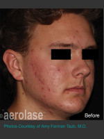 Before Photo NeoClear by Aerolase Acne Treatment - Prejuvenation Before & After