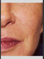 After Photo Vbeam Pulsed Dye Laser treatment of Rosacea - Prejuvenation Before & After