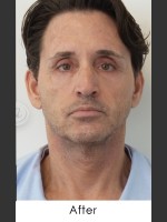 After Photo Sculptra Rejuvenation for Man - Prejuvenation Before & After