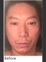 Before Photo Sculptra for Male Facial Rejuvenation - Prejuvenation Before & After