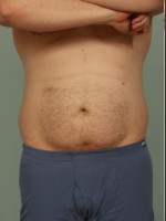 Before Photo Liposuction - Prejuvenation Before & After