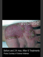 Before Photo Treatment of Psoriasis #335 - Prejuvenation Before & After